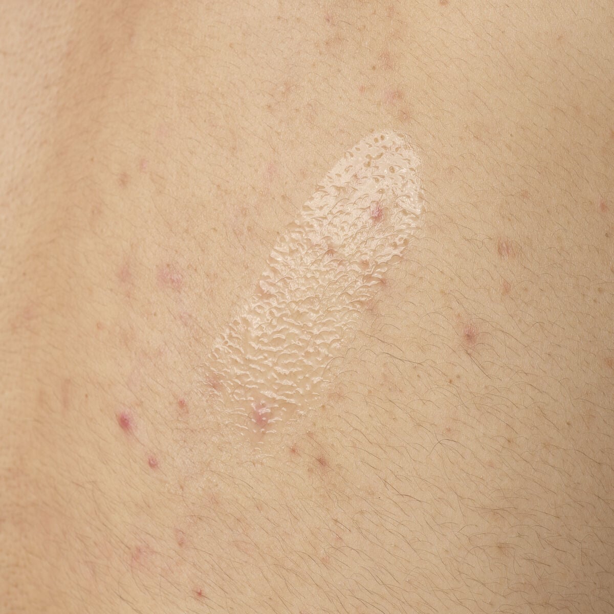 salicylic-acid-0-5-body-serum-x1 ORD-salicylic-acid-05-body-240ml-application.jpg