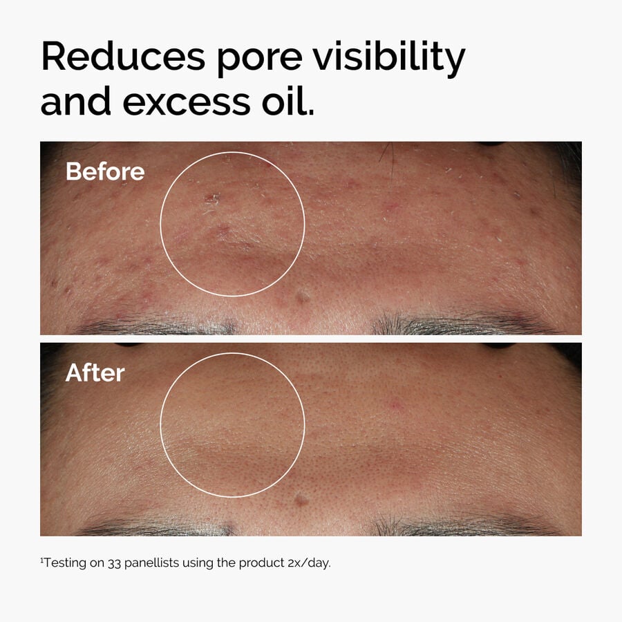 niacinamide-10-zinc-1-w1 ord-niacinamide-zinc-blemish-serum-before-after-pores.jpg