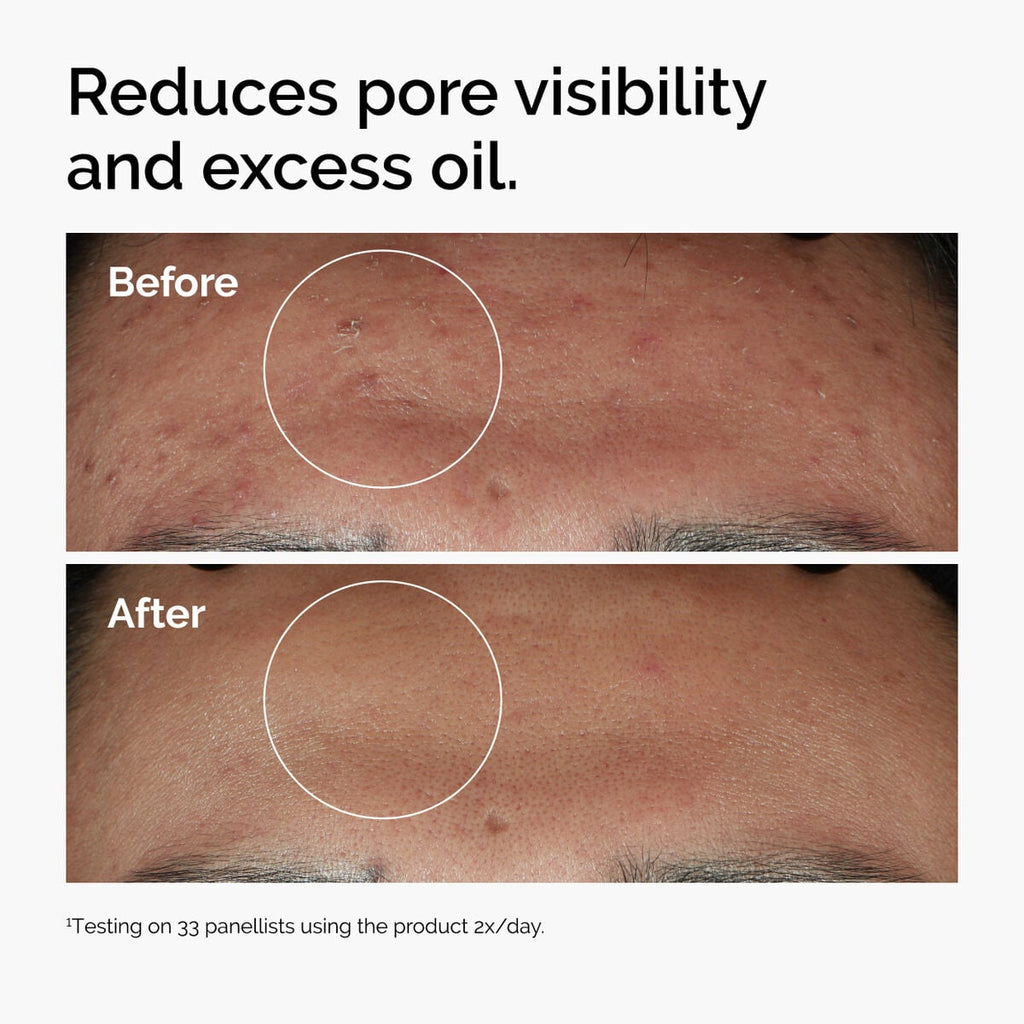 niacinamide-10-zinc-1-w1 ord-niacinamide-zinc-blemish-serum-before-after-pores.jpg
