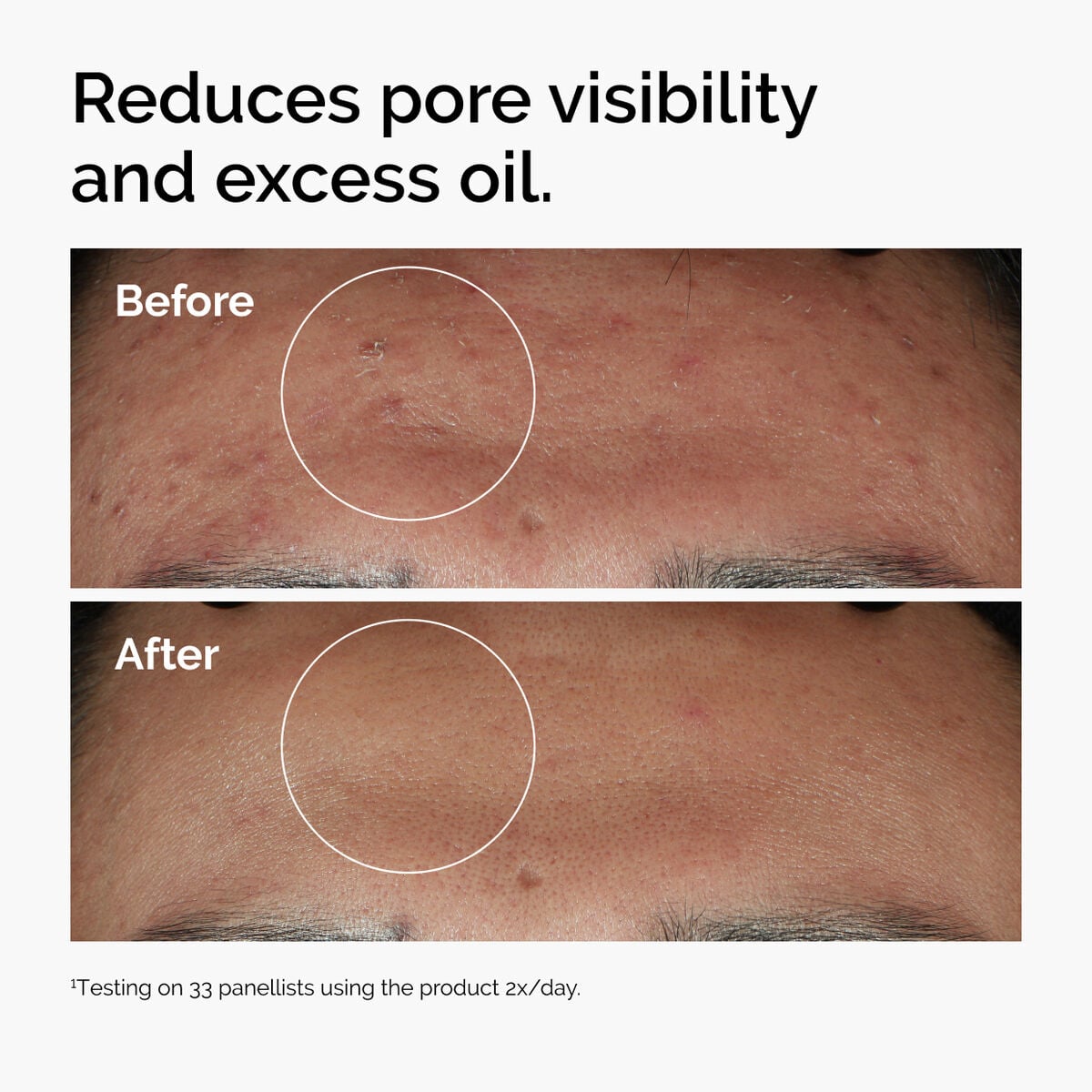 niacinamide-10-zinc-1-w1 ord-niacinamide-zinc-blemish-serum-before-after-pores.jpg
