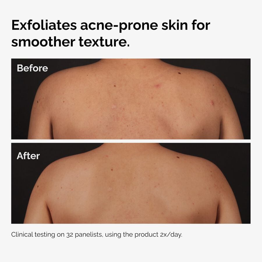 salicylic-acid-0-5-body-serum-x1 ord-salicylic-acid-body-serum-before-after-graphic-NA.jpg