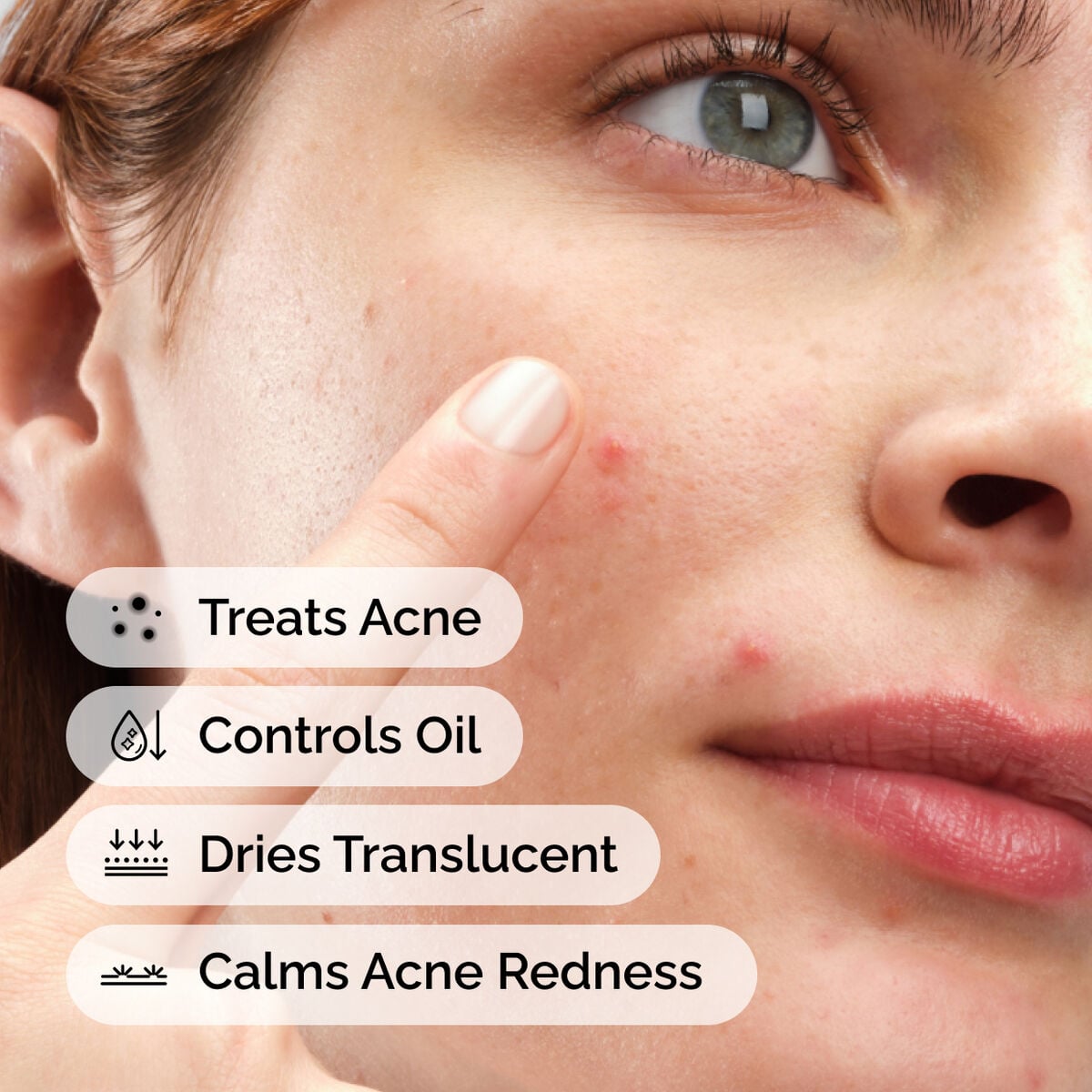 sulfur-10-powder-to-cream-concentrate-u4 ord-sulfur-10pct-powder-to-cream-concentrate-model-application-with-benefits-acne.jpg