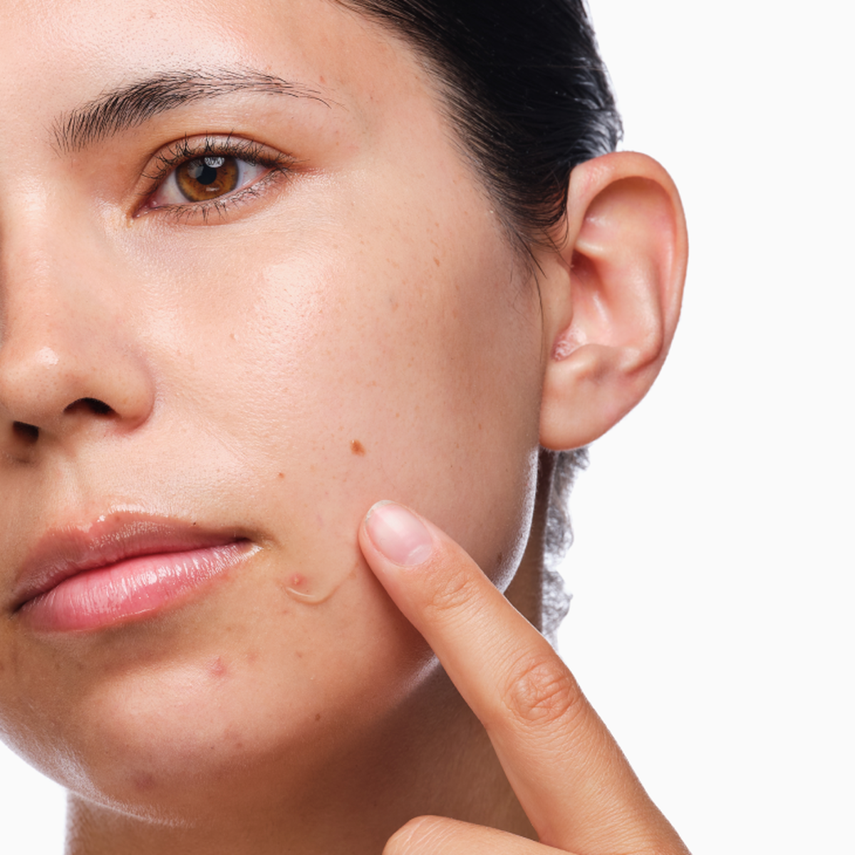 the-acne-set-m0 rdn-the-acne-set-application.png